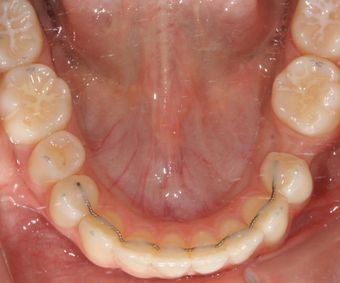 Lückenschluss bei Nichtanlage Zahn 35