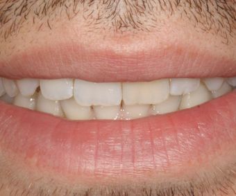 Engstand mit ankylosiertem Zahn 21