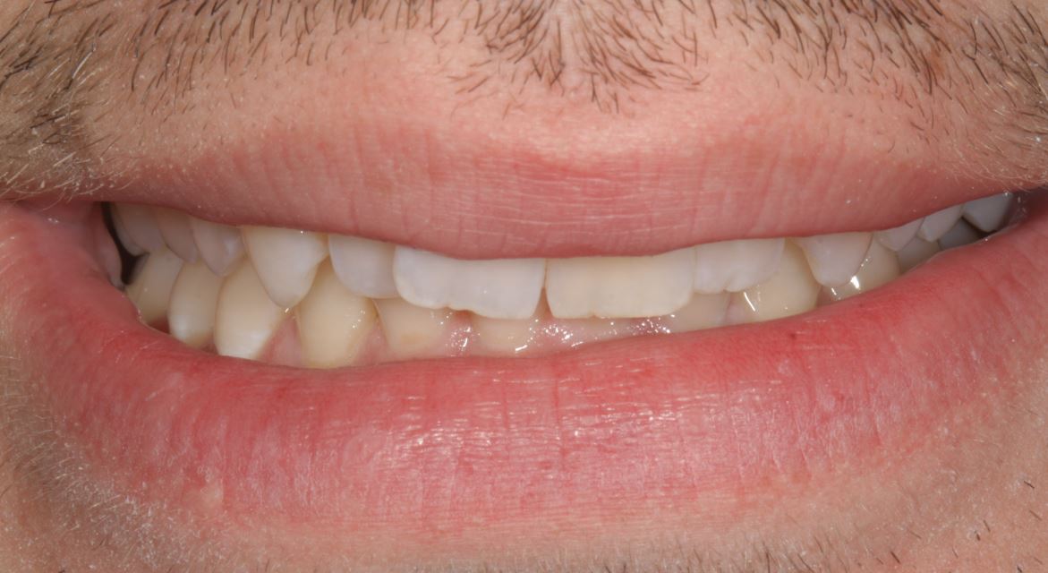 Engstand mit ankylosiertem Zahn 21